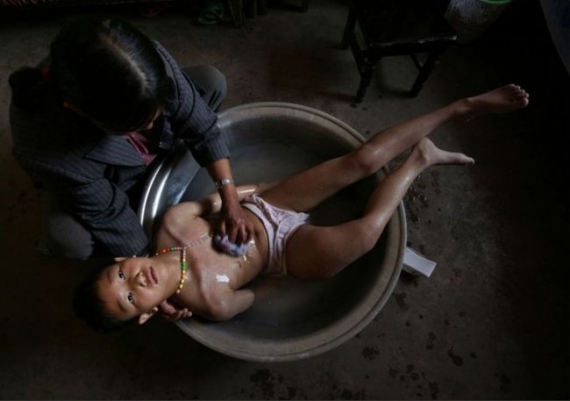 Xu Li, 11 lat, żyjący w Xuanwei w prowincji Junan ma raka kości Xu Li, 11 lat, żyjący w Xuanwei w prowincji Junan ma raka kości